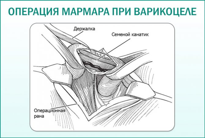 Варикозное Расширение Вен Семенного Канатика Лечение